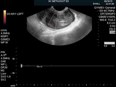 test for ovarian torsion|fixation of a displaced ovary.